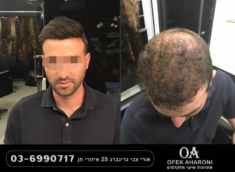 מילוי קרחות - הפתרון המתקדם להחזרת שיער מלא וביטחון עצמי