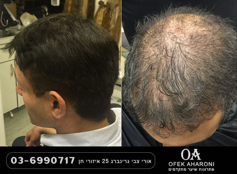 דלילות שיער – כל מה שצריך לדעת על דלילות שיער ואיך לטפל בה בצורה הטובה ביותר